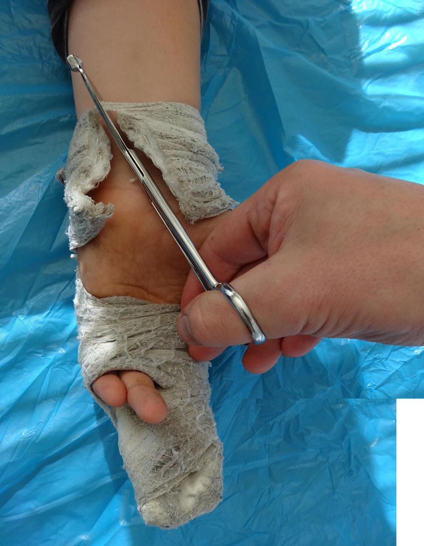 Eile patsiendilt Listeri kääridega kipsi eemaldanud Madis Veskimägi toonitas, et seda peaks alati tegema arst, kuna tavaliste kääridega võib nahka sisse lõigata.
