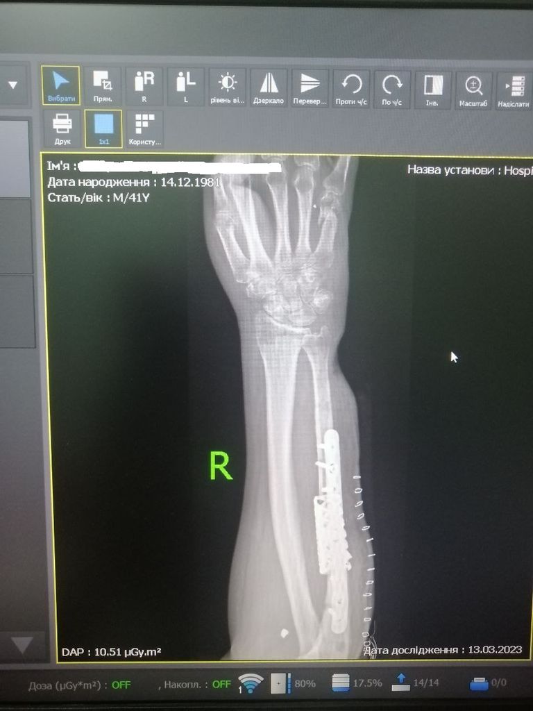 Рентгеновский снимок реконструкции предплечья при помощи импланта, напечатанного на 3D-принтере. Операция проводилась в Белоцерковском госпитале, хирург - Иван Козар.