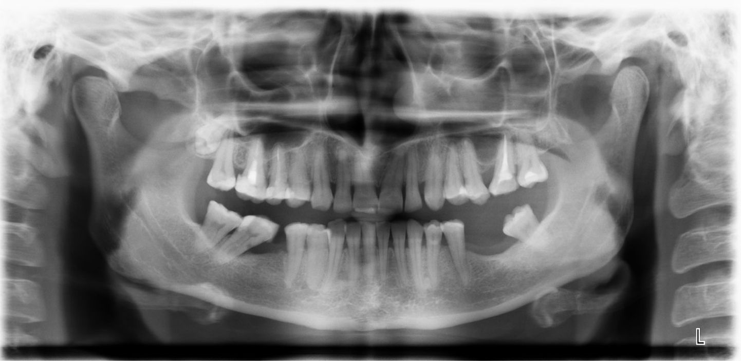 Pärast  hammaste väljatõmbamist võib teiste hammaste asend tühja koha tõttu muutuda. Enamasti läheb selleks aastaid, kuid muutus võib toimuda ka kuudega. 