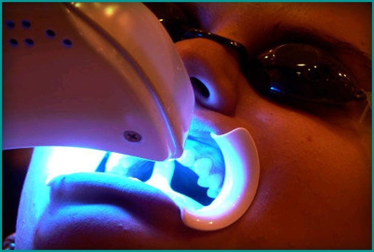 Отбеливание зубов считается косметической процедурой, но у нее могут быть опасные побочные эффекты.