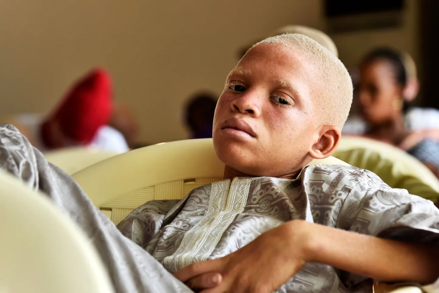 Senegalist pärit albiino. Foto on illustreeriv.