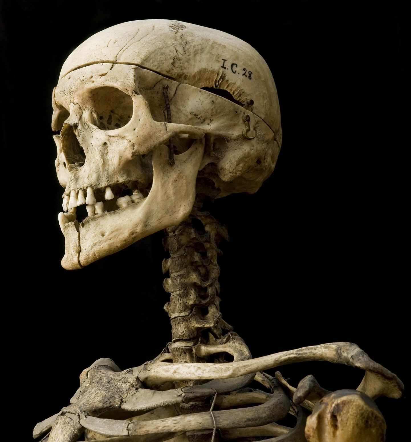William Burke’i skelett asub tänaseni Edinburghi ülikooli kirurgiamuuseumis. Häbipostis oma võigaste kuritegude eest, paneb see eksponaat muuseumikülastajad kindlasti meditsiinieetika üle juurdlema.