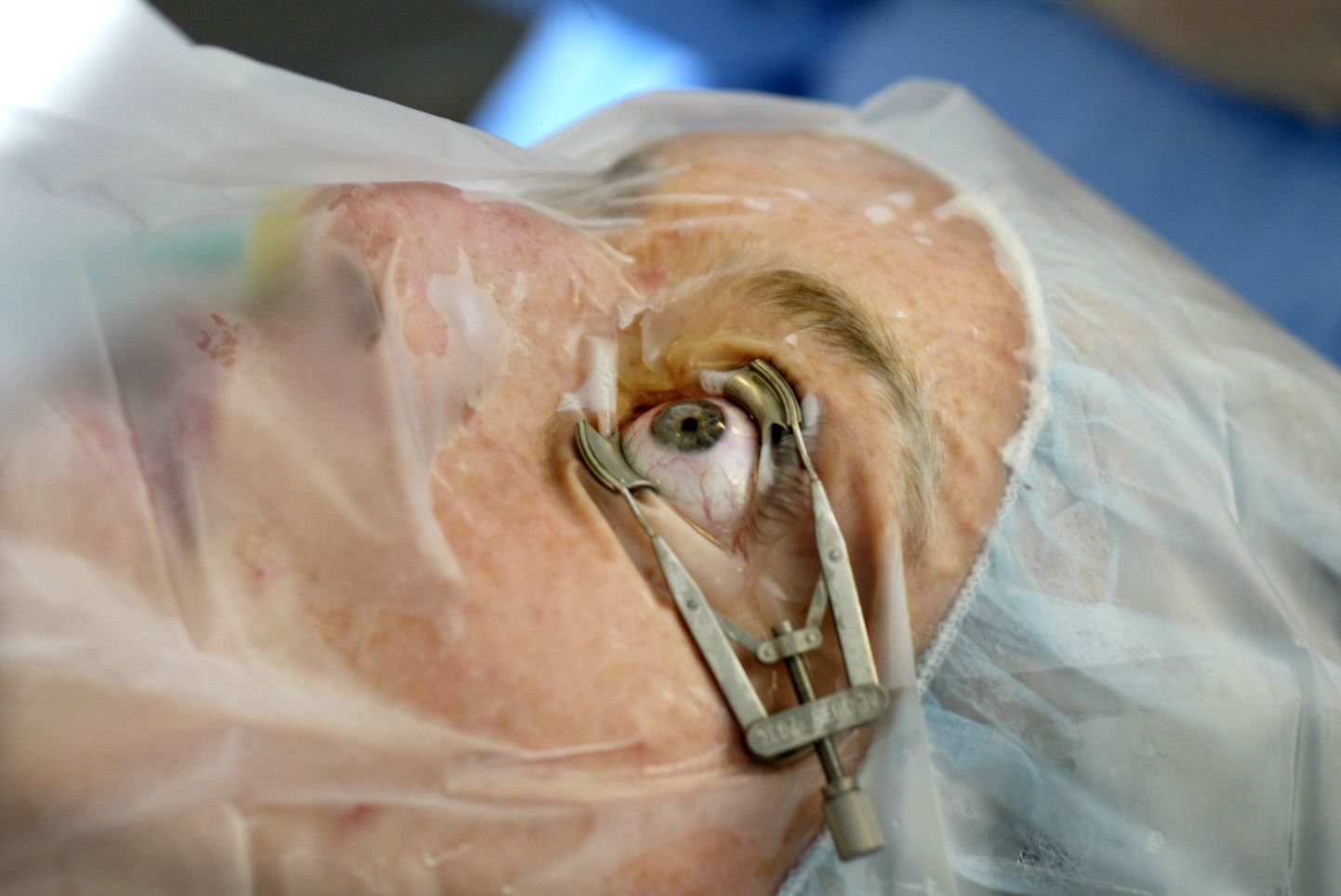 Arstid eemaldasid laseri abil ussi silmast
