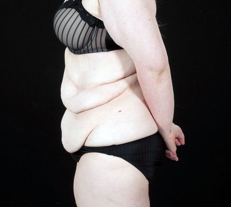 Selline oli esialgu tulemus pärast kilode kaotamist. Foto: Martin Hunter/ Caters News Agency / Scanpix.